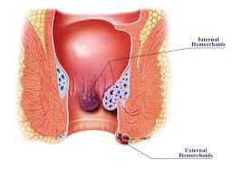 Hemorrhoids grade I