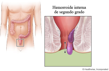 hemorrhoids grade II