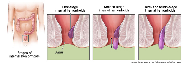 hemorrhoids grade III and IV