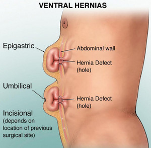 hernias-vista-lateral